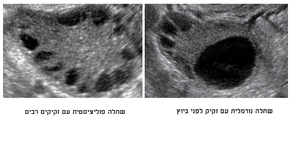 ציסטה בשחלה